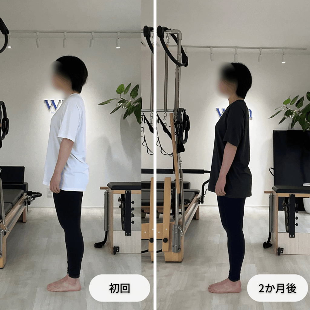 初回と2か月後の立位姿勢を側面から比較した写真