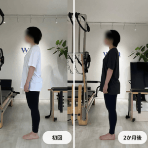 初回と2か月後の立位姿勢を側面から比較した