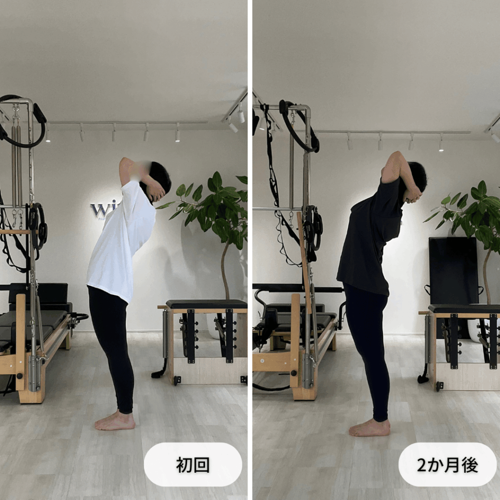 初回と2か月後の後屈動作を側面から比較した写真